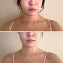 강남메디 | 강남역피부관리 ㅣ웨딩관리 추천 역삼 메디스파 승모근 데콜테 집중관리 후기