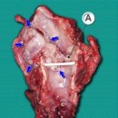 후두암 (Laryngeal Cancer) 이미지