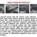 Cystic Parathyroid Adenoma 이미지