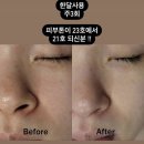 다올의료기 | 집중✊소녀들❗️초 리얼후기‼️기미,잡티고민 소녀들 ! 김태리 앰플 ! 마지막 기획전 이벤트 총정리!