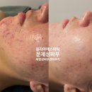 신미선 | 여드름, 지루성피부염 피부과 약 없이 '이것'으로 잡았습니다.(볼리아에스테틱 문제성피부관리 리얼 후기)