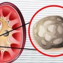 남성 괴롭히는 요로결석…견과류·시금치 멀리하고 물과 친해지자 이미지