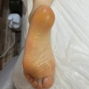 힐링메이드 | 대전 패디플레닝 발각질제거 전후차이 대박 결메이드 후기