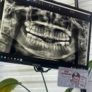 아름다운휴치과의원 | 천안 사랑니 맛집 리건치과(강추)/ 매복사랑니 발치 후기