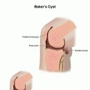 슬개 활액낭염(Baker`s cyst,) 이미지