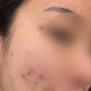 성인여드름 얼굴 이마 모낭염 극복기 2탄-라라젯 LHA 모공청소 필링 내돈내산 후기