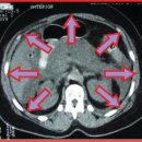 구획증후군 1 (Compartment Syndrome) 이미지