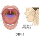 편도염 급성 만성 세균성 원인 열 전염 약 및 아이스크림 이 있을지 이미지