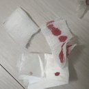 청담케이팜약국 | 강남 신사 돌출점 제거 후기(feat. 일주일 회복 후)