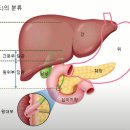 간경화증의 합병증 - 복수 이미지