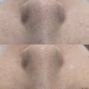 제이샵뷰티 - 북구 학정동 | 광주 양산동 피부관리 제이샵뷰티 : 여름철 필수인 모공관리 솔직후기
