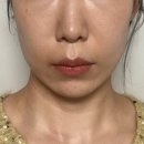 라이징스타골프 | 강남역피부과에서 레이저리프팅계의 라이징스타 볼뉴머 체험기