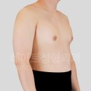 진성바이오 | 6월 여유증 수술 괜찮을까? 수술 2주 후 경과
