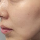 망우역 | 상봉피부관리 에스테티아망우역 DMTS 관리후기