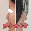 들창코 | 짧은코수술, 전 꼭 알아야할 원인과 수술 방법 ㅣ 들창코교정