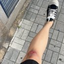 [리뷰]대구뽀빠이정형외과(다리 찰과상 진료후기)