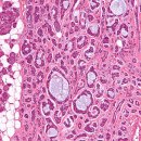 침샘(선조직)에서 발생하는 상피성 악성 종양(암) 선양낭포암(Adenoid Cystic Carcinoma, ACC) 이미지