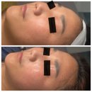 45 | 내돈내산 서산 에스테틱 추천 룩서스 플라즈마 시리뷰티 주근깨 잡티제거 전문 피부관리샵 피부진단 및...