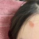 대웅한의원 | [다이어트 50일차] 20250401(화) 본식 앞두고 화상이라니