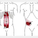 복직근 연관통증[Rectus Abdominis Referral Pain] 이미지