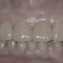 닥터굿플란트치과의원 | 앞니 치료 당당하게 상악 전치부 임시치아의 중요성(feat.닥터굿플란트치과의원)