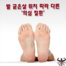 발 굳은살 위치에 따라 의심질환 이미지