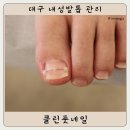 클린풋 | 대구 내성발톱 관리 : 클린풋네일