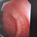 제인산부인과의원 | [자궁내막암 1기 진단] 삼성서울병원 산부인과 진료 과정 및 소요 기간&amp;보험서류 안내