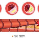 심장환자의 약물관리 (항혈소판제제, 항응고제) 이미지