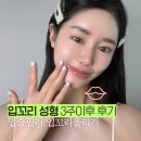 리얼미의원 | 신사 입꼬리필러 후기, 리얼 내돈내산