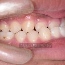 어린이 자세교정(초등학교 1~3학년) | 치아교정 시작 시기, 심한 비뚤함 발치교정 후기로 보는 성인과 성장기 어린이 비교