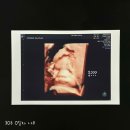 세종충대약국 | 30 - 31w 쌍둥이 주수기록 • 배크기 • 세종충남대병원 경부길이 30주 1.4cm • 청주 백일해 무료접종...