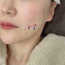 언주한의원 | 언주역 한의원 실리프팅 무너진 얼굴라인 턱라인 실리프팅 후기 전후