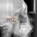 돌출입 양악수술 vs 돌출입수술..적용점과 효과가 다릅니다. 이미지