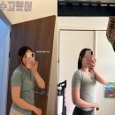 어서멍 | 청담피부과 팔뚝 바디 온다리프팅 8만줄 &amp; 지방분해주사 가격 통증 부작용 내돈내산 후기