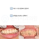해드림치과의원 | 심미보철 내 치아보다 자연스럽게 할 수 있는 방법
