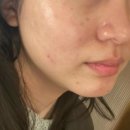 광주사 | 리쥬란, 물광주사 손주사로 같이 맞은 3회차 찐후기 (feat. 공장형피부과 멍, 붓기, 엠보 3종 세트)