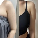 바디제로 | 신사 제로의원 바디 온다리프팅 팔뚝 후기 비포애프터｜본식 전 신부관리 추천