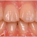 밝은미소약국 | 앞니라미네이트? 16년 차 의사는 말리는 이유 (부작용, 후기)