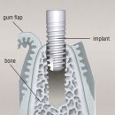 임플란트 시술순서 알려드릴께요 이미지