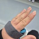 요골 | 원위요골골절 1~7주차 후기