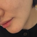 오늘안피부과의원 | 강남구청역피부과 루피엘의원 세르프 300샷 후기 내돈내산 솔직후기