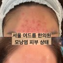 네오한의원 | 한의원 방문 피부 상태 / 피부과 vs 한의원 / 성인...치료 / 30대 여드름 / 피부과 압출 후기 / 압출흉터