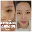 수영구피부관리 소예에스테틱 하이드로셀 1회로 피부 속 채우기
