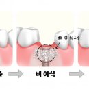 웰치과기공소 이미지
