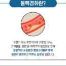 동맥경화 원인 및 증상 예방은 어떻게 할까요? 이미지