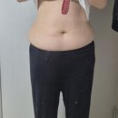 블리핏 | 인천구월동피부과 뱃살 러브핸들 블리핏 바디 복부지방분해주사 180cc 3회후기 효과