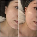 깊은 울림이 있는 팬플릇 | 부산 동래피부관리 울림에스테틱 여드름압출케어 후기 🐛