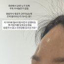 그때그대패 | 염증주사부작용 : 염증주사함몰 염증주사패임 한달뒤 상태