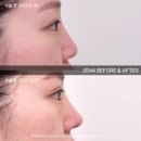 코코성형외과의원 | [코 성형] 제나 성형외과, 코코 성형 후기 전후 ❤️